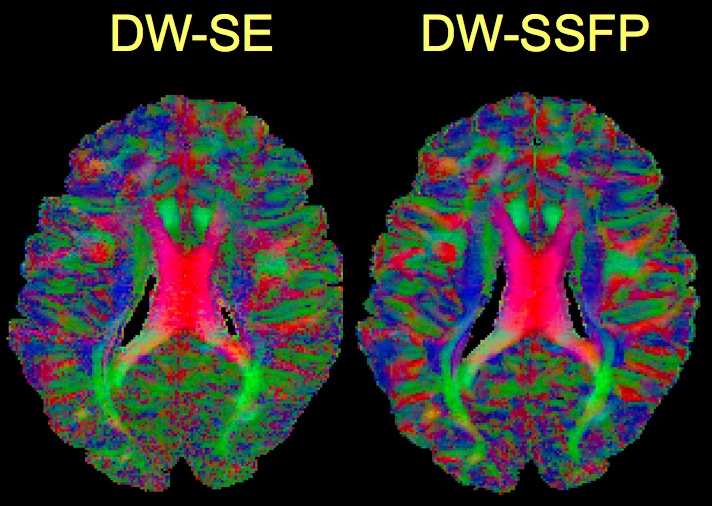 Diffusion-Weighted Magnetic Resonance Imaging
